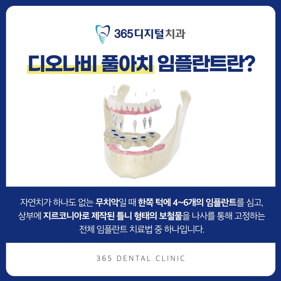 둔산동 풀아치임플란트 치아 저작과 침 분비로 소화 부담 감소 감염 방지 방법