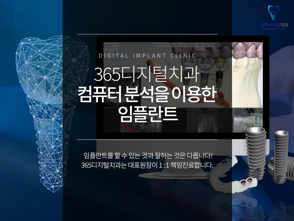 둔산동 전체임플란트 치아 상실 방치 시 인접치 이동과 부정교합 주의사항 확인