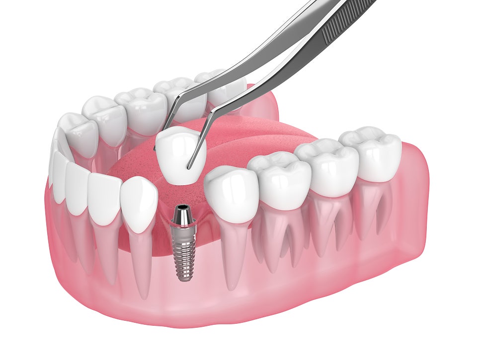 둔산동 전체임플란트 3D CT 구강스캐너 프린트 활용 검진 방법과 계획