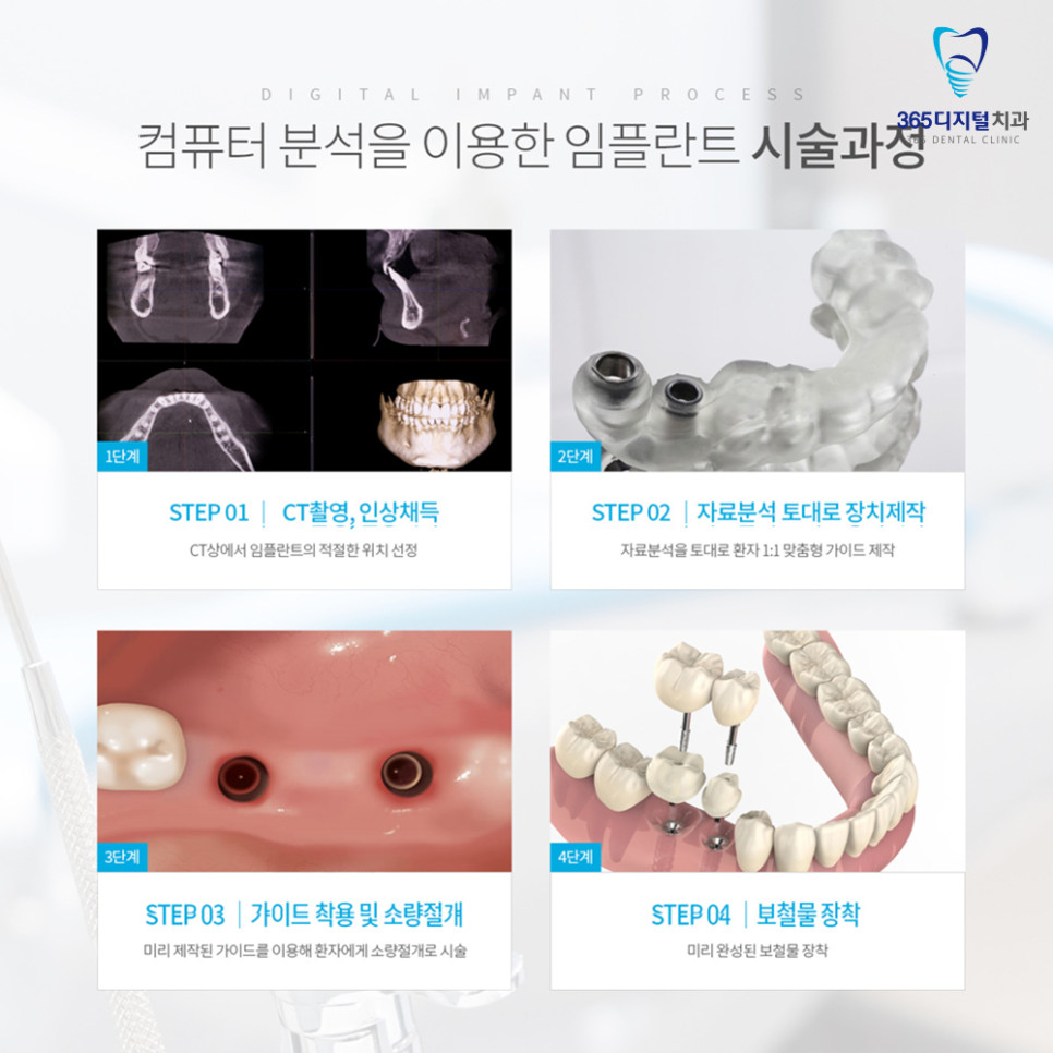 둔산동전체임플란트 치아 빈자리 방치 시 주변 치아 이동과 치열 변화 주의사항
