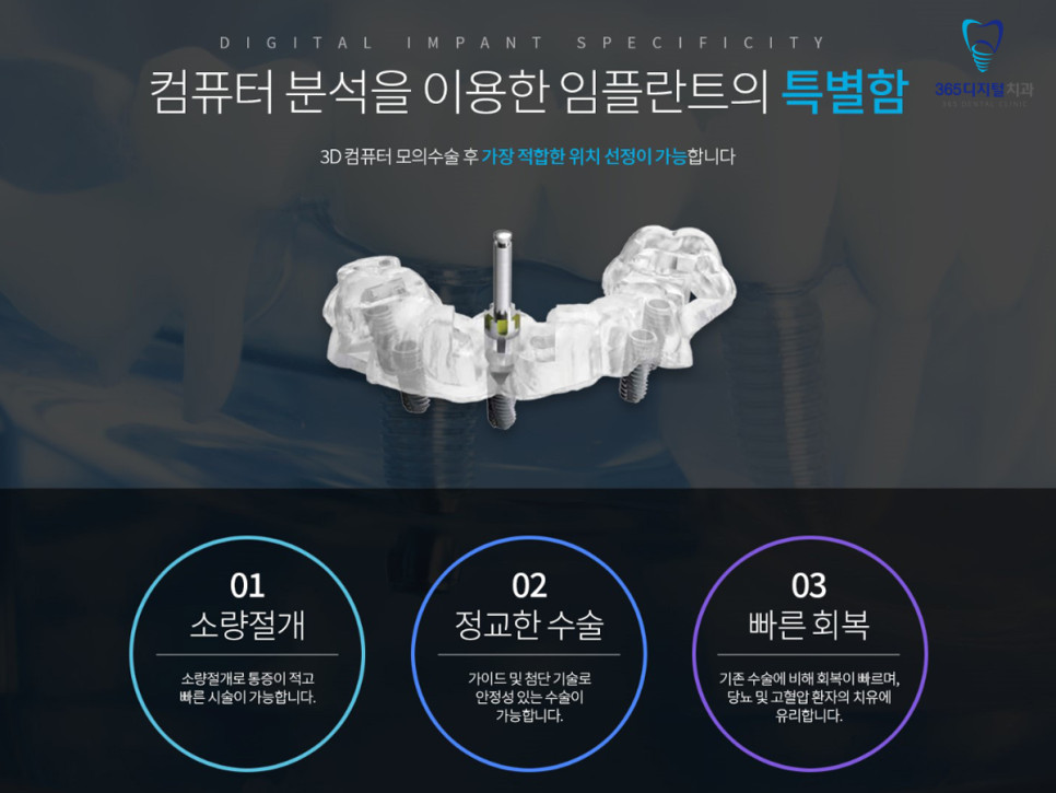 둔산동 전체임플란트 방법 잇몸뼈 인공 치근 식립과 지대주 보철 연결 과정
