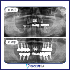 증례1