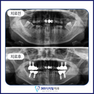 둔산동 풀아치임플란트