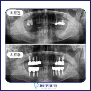 둔산동 전체임플란트
