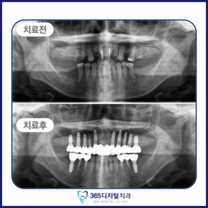 둔산동 전체임플란트