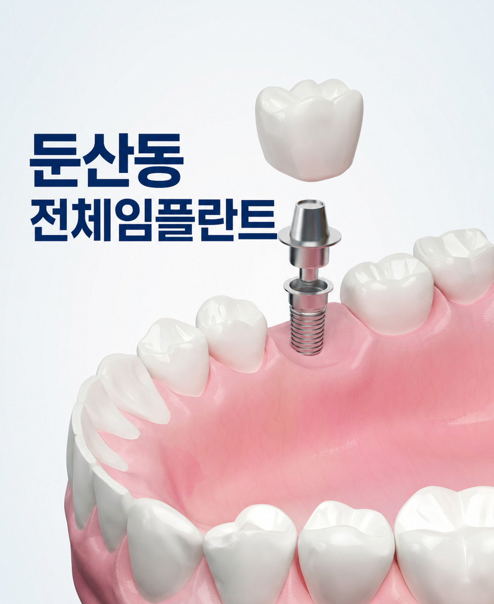 둔산동 전체임플란트 치아 건강 방치 위험과 정기 치과 검진 초기 치료 필요성